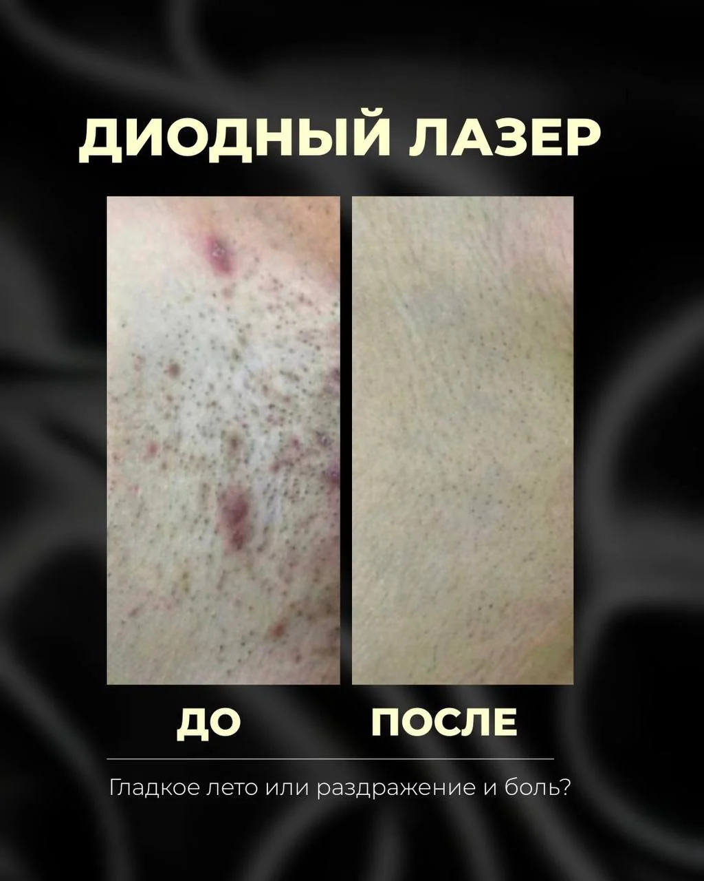 Лазерная эпиляция